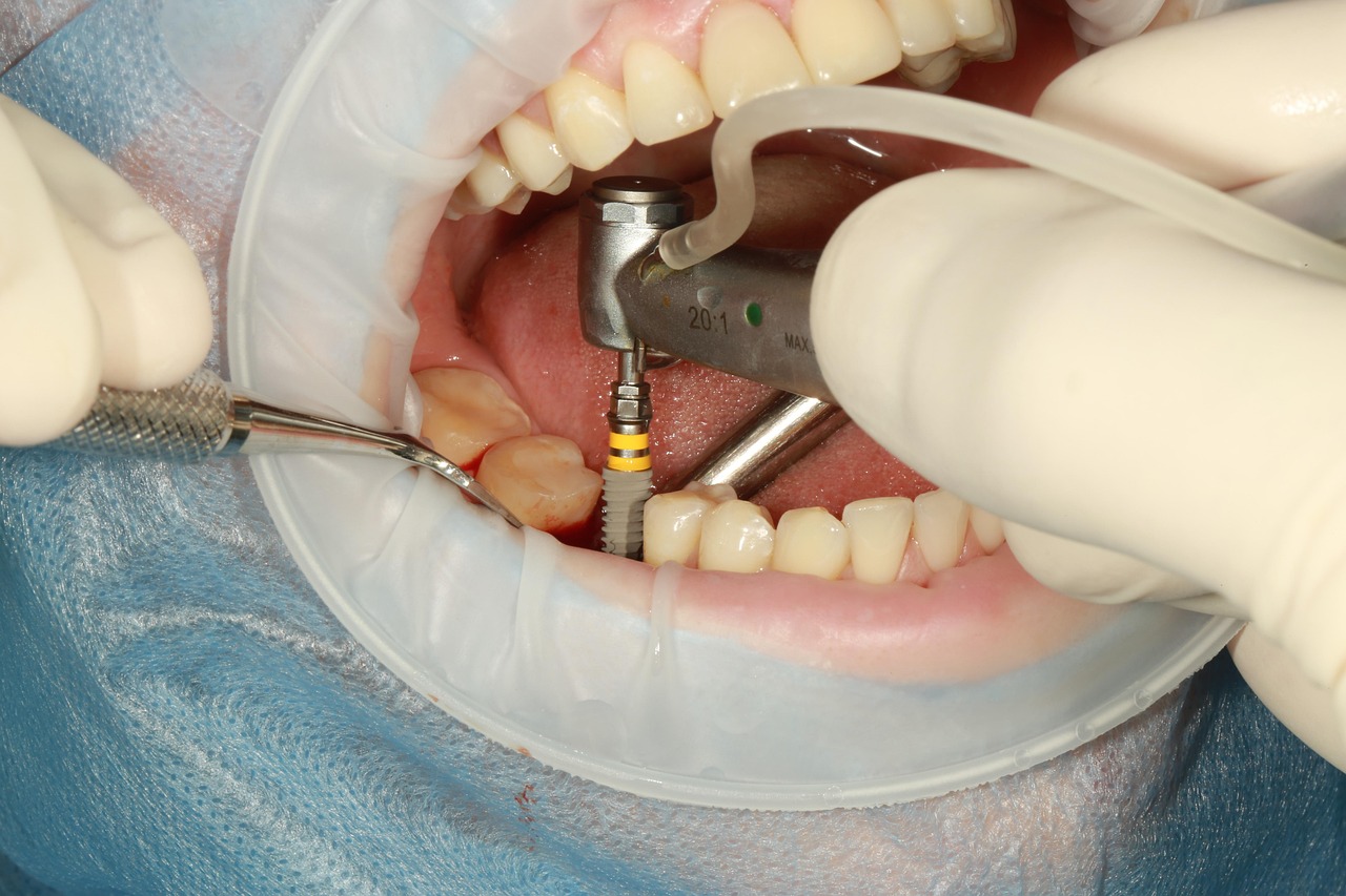 implantát